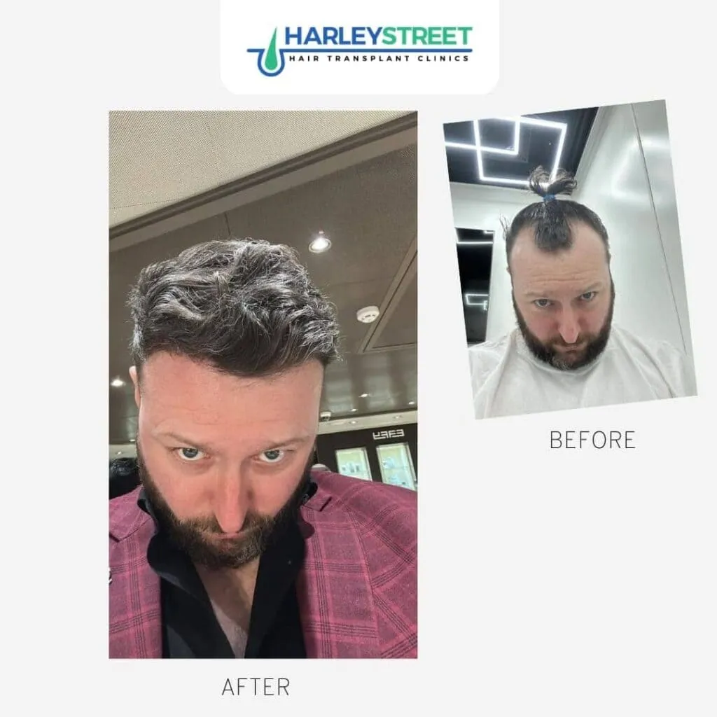 Hair Transplant York 1 Gerard-Before-After-1