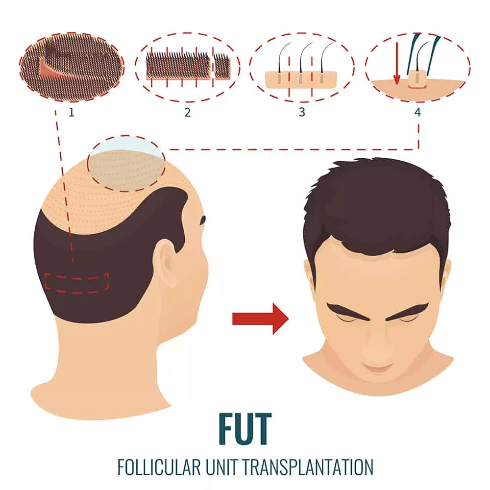 Home 3 46 FUT stages treatment