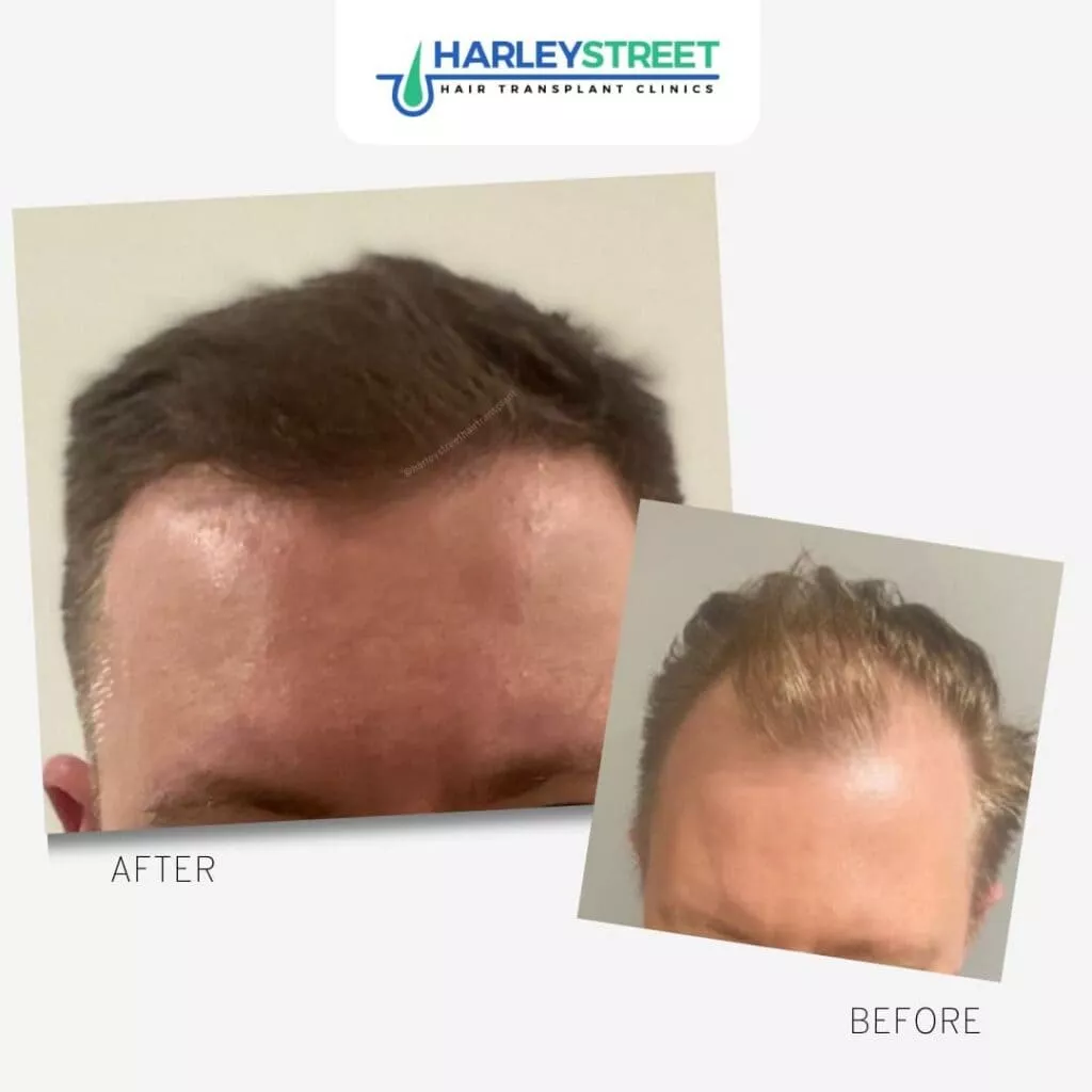 Home 3 12 Harley St before and after front hairline and temples