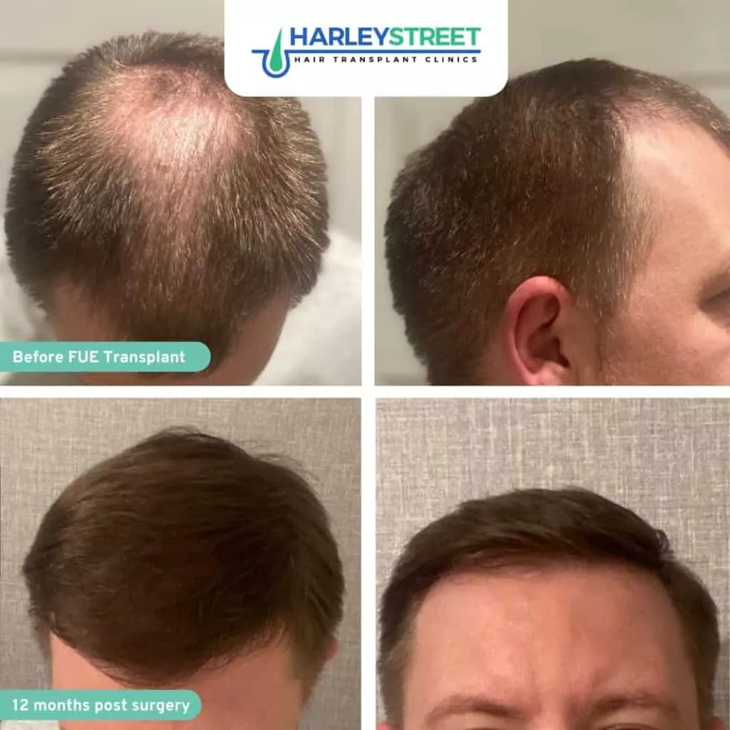Home 3 11 Harley Street HT Clinics crown and hairline before and after
