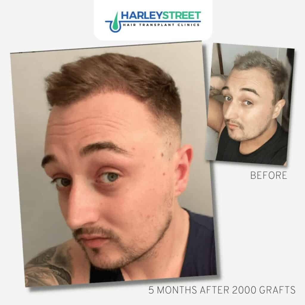 Before and After Results 13 FUE-Before-and-After-2