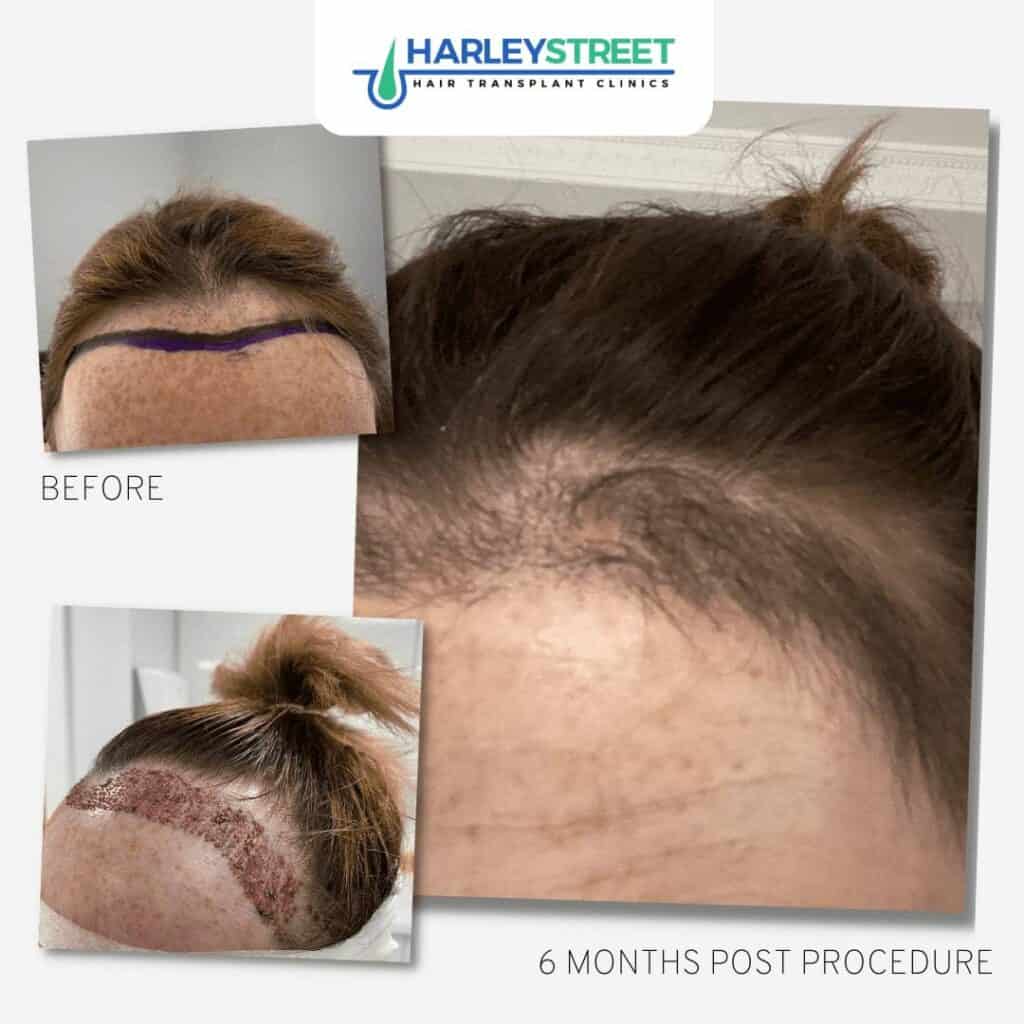 Before and After Results 15 FUE-Female-Hair-Transplant-Before-and-After