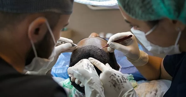Does Testosterone Cause Hair Loss? Hair Transplant Surgery: Note the transplanted hair being placed in the frontal hairline in the image above.