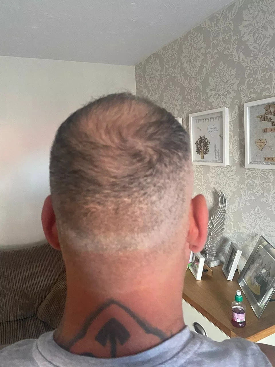 What is An Overharvested Donor Area 5aa4798e 5995 45bb a9ea 75603c88ee45