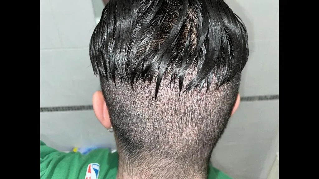 Donor Area for Hair Transplant 5c1de1f0 174b 457e bb53 da07d369e2ed