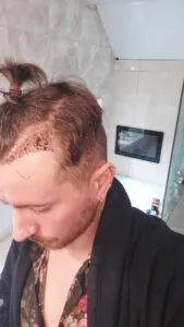 Hair Transplant Scabs 2 weeks post ht after unshaven