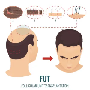 Do Hair Transplants Work? FUT Hair Transplant Procedure-min