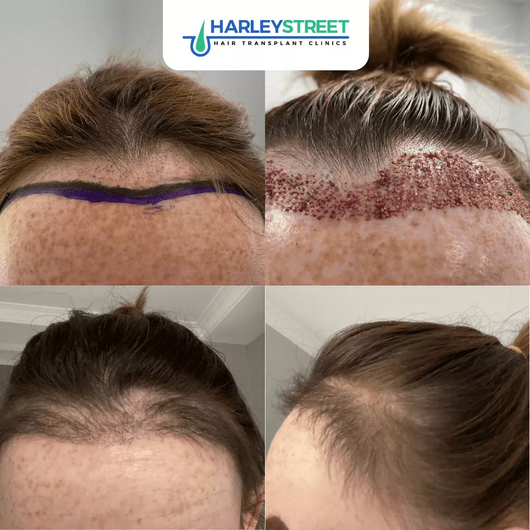 Receding Hairline in Women harley street hair transplant fue procedure for female hair loss