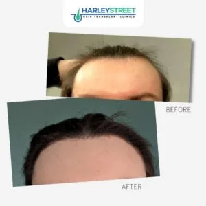 Transgender Hair Transplant Alex trans patient before and after