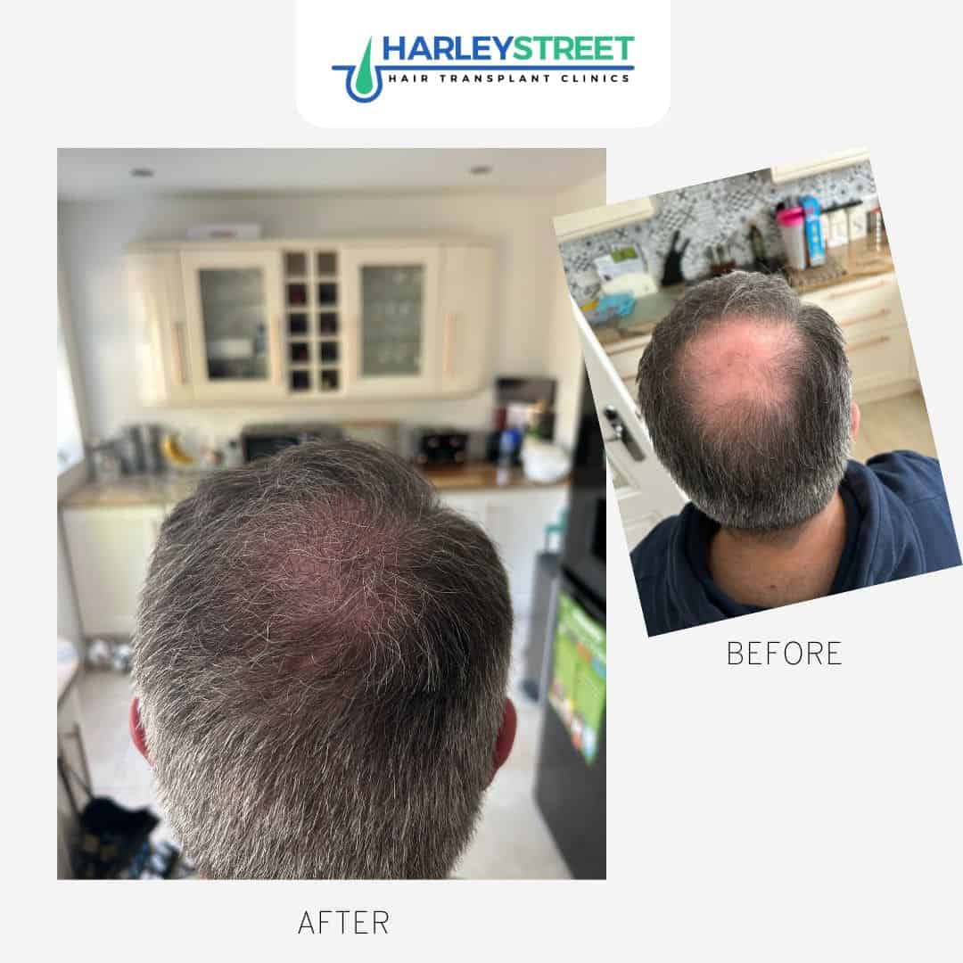 Crown Hair Transplant Before and after crown ht chris h