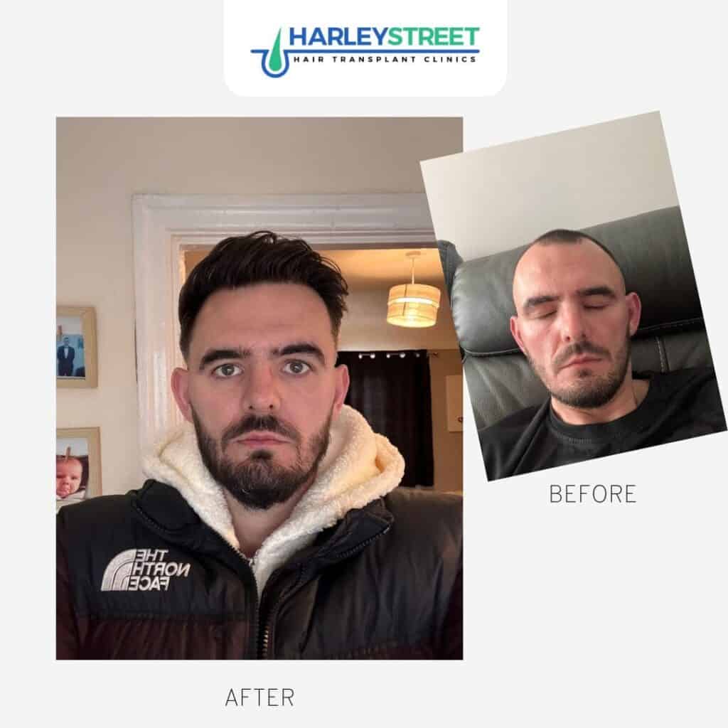 Harley Street Hair Transplant Clinics London Home Page Before and after ht ryan g