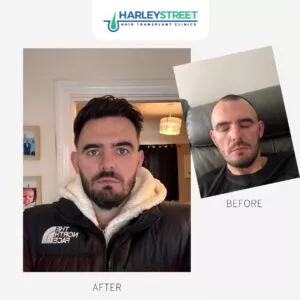 Hair Transplant Cost at Harley Street Before and after ht ryan g
