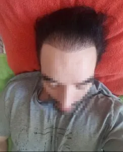 Why Do Hair Transplants Fail ? Botched Turkey Ht
