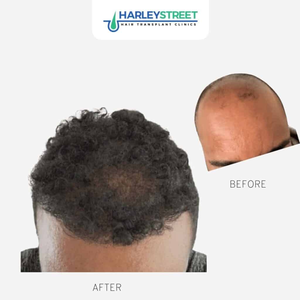 Harley Street Hair Transplant Clinics London Home Page Calvin Before & Afters