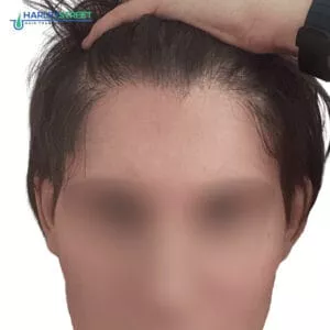 Hair Transplant Timeline Charlotte Lloyd 6 months