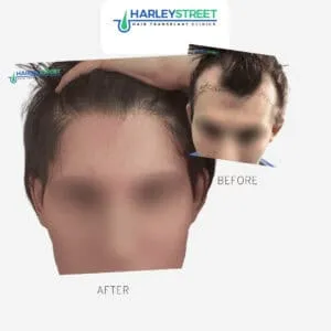 The Baldness Gene: Hereditary Hair Loss Explained! Charlotte Lloyd - before and after