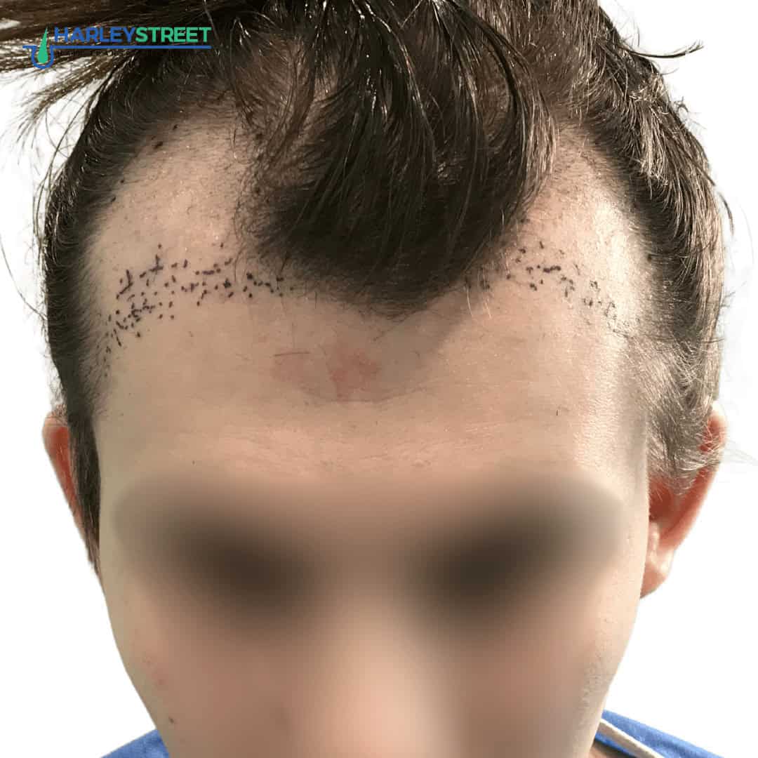 Regrowing Your Hairline After Postpartum Hair Loss: Proven Methods 