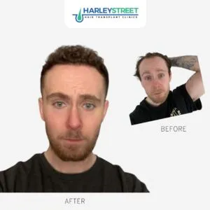 Hairline Hair Transplant Cost Declan Before & Afters