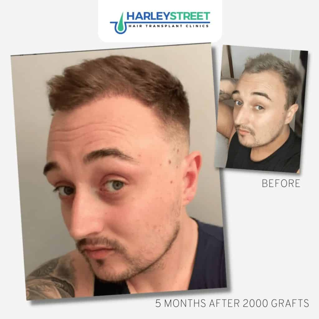 Free Consultation FUE-Before-and-After-2