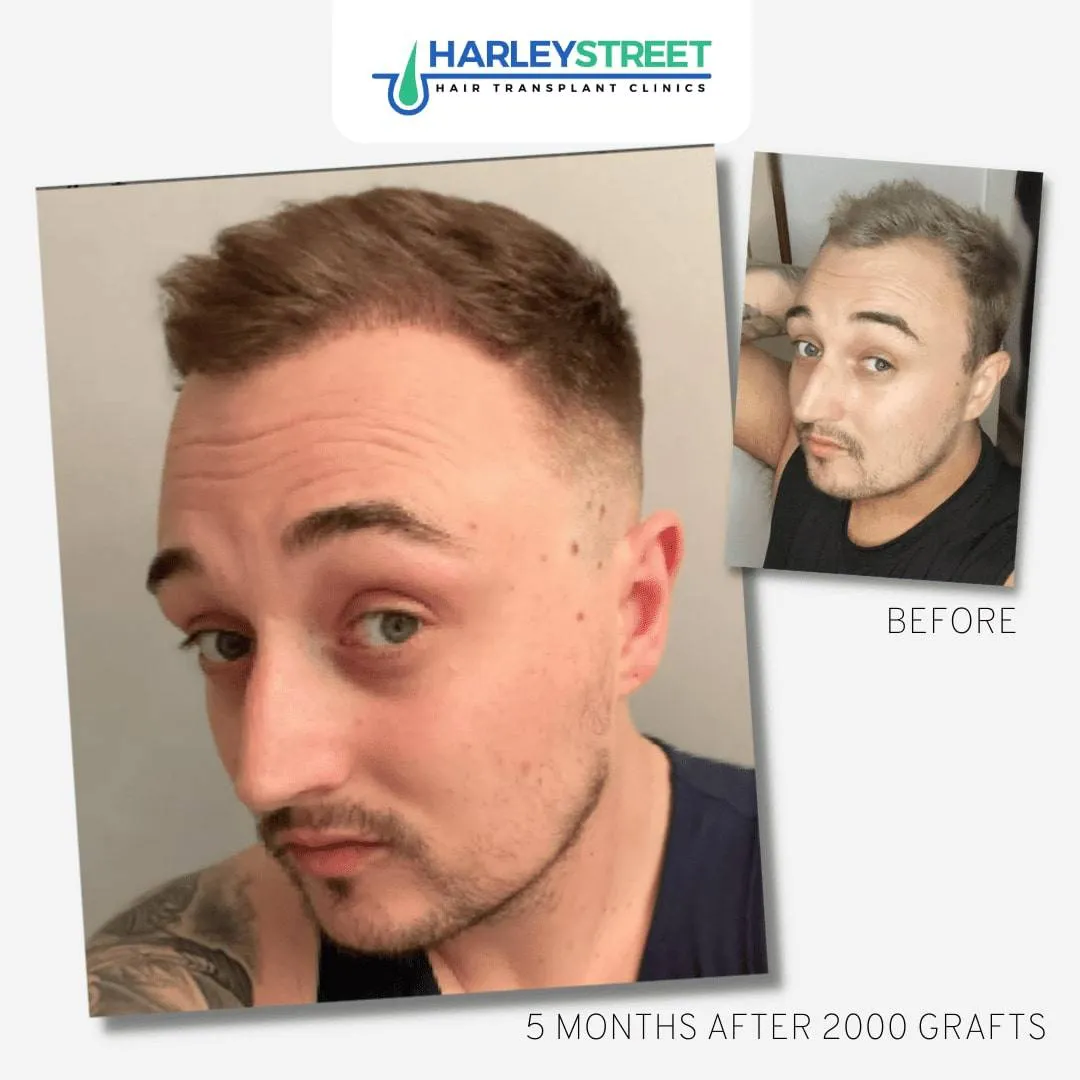 Hair Transplant Before and After Results FUE-Before-and-After-2