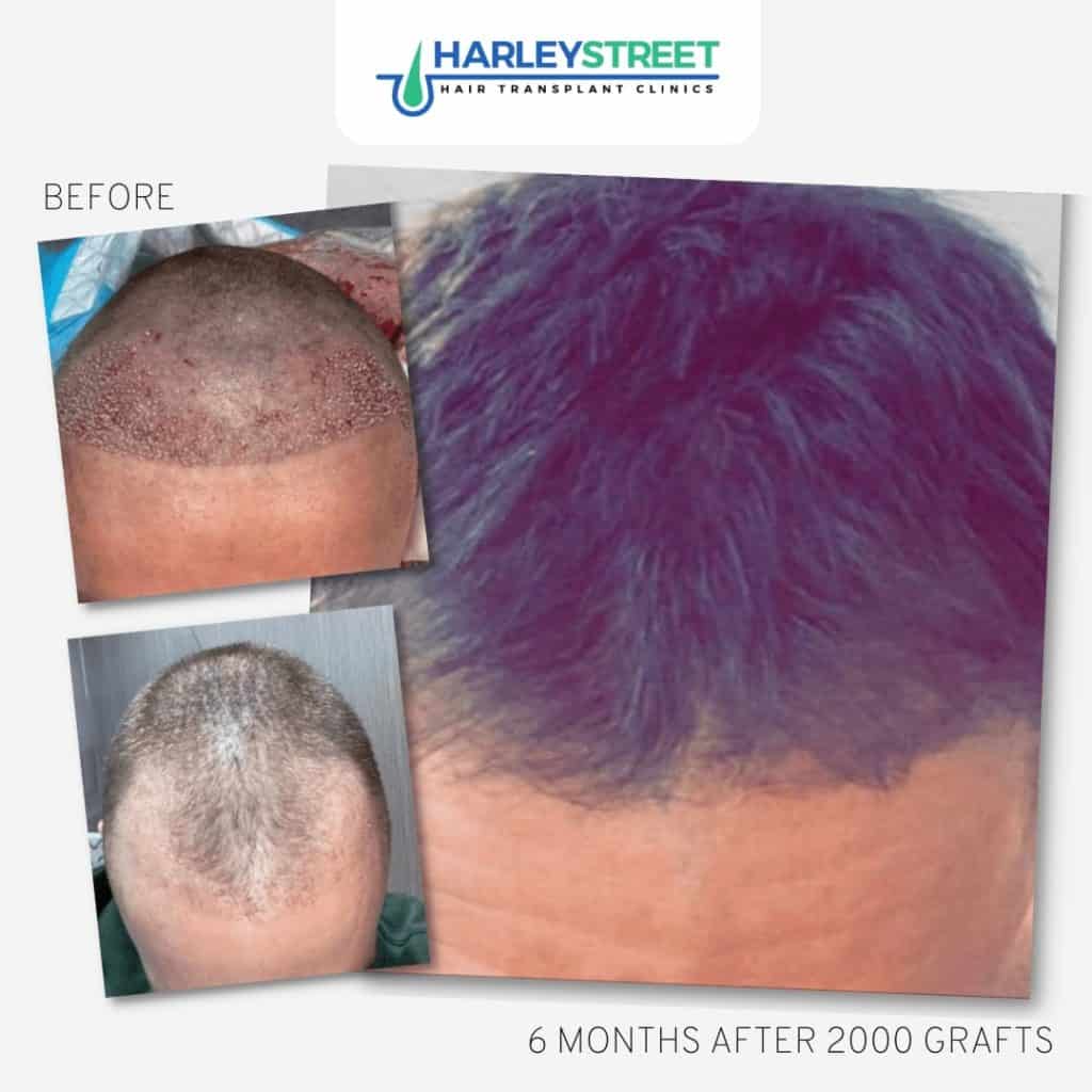 Harley Street Hair Transplant Clinics London Home Page FUE-Before-and-After-9