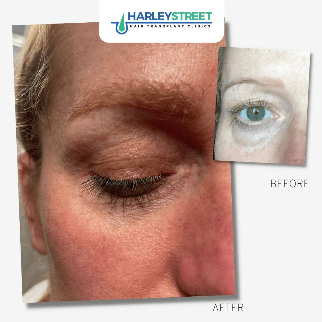 Hair Transplant Before and After Results FUE-Eyebrow-Transplant-Before-and-After-14