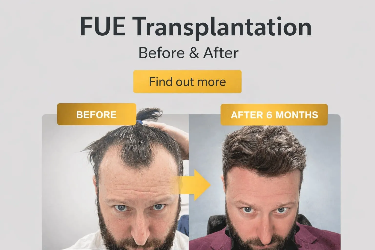 Harley Street Hair Transplant Clinics London Home Page FUE Hair Transplantation