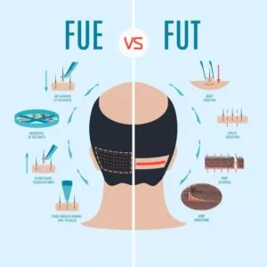 FUE Hair Transplant 6 FUE vs FUT in hair transplant methods min