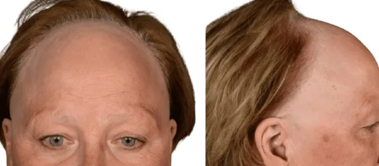 Frontal Fibrosing Alopecia Frontal Fibrosing Alopecia