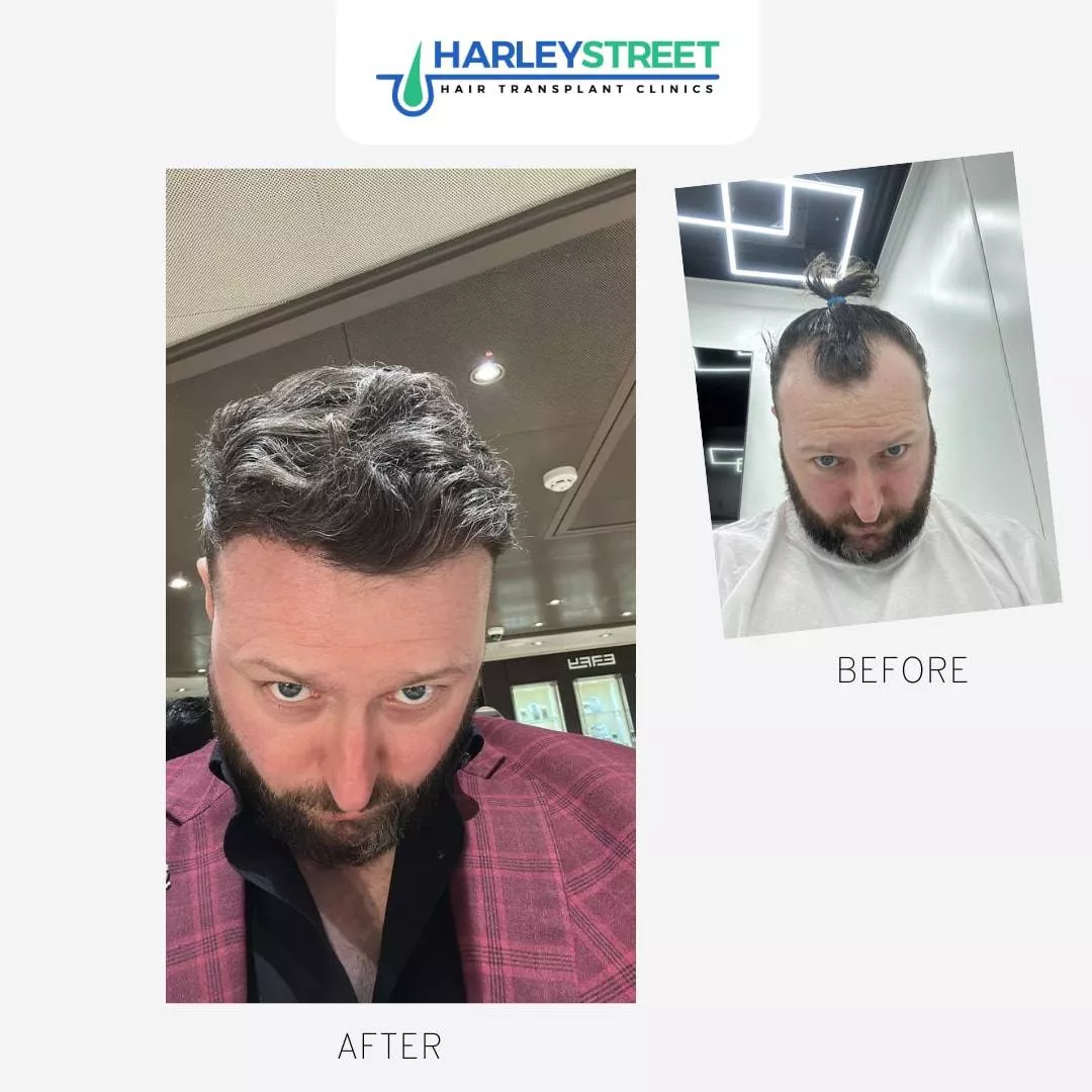 Hair Transplant Nottingham Clinic Gerard Before & After