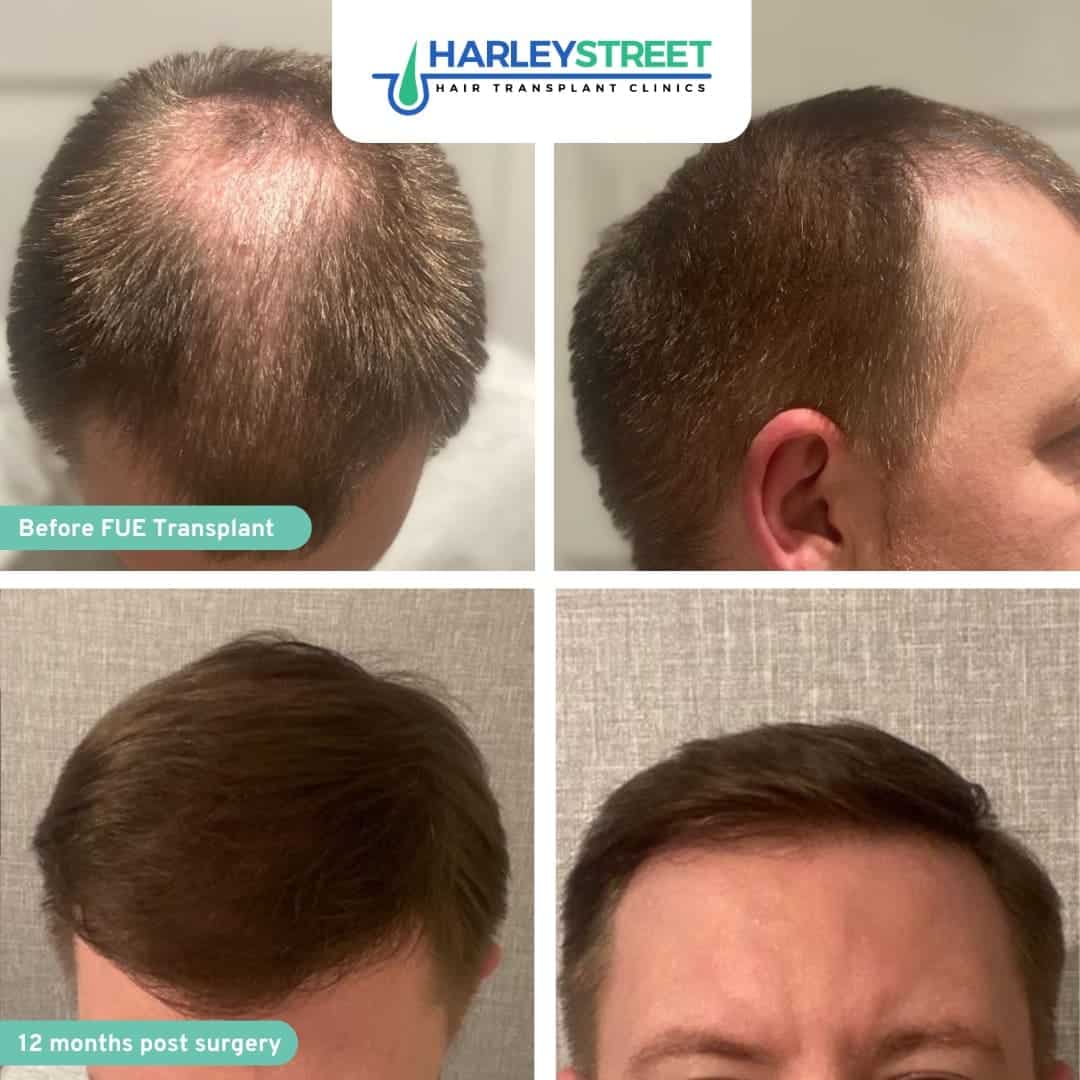 Crown Hair Transplant Harley Street HT Clinics crown and hairline before and after