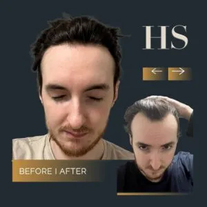 Hairline Hair Transplant Harley Street HT Clinics pt E black
