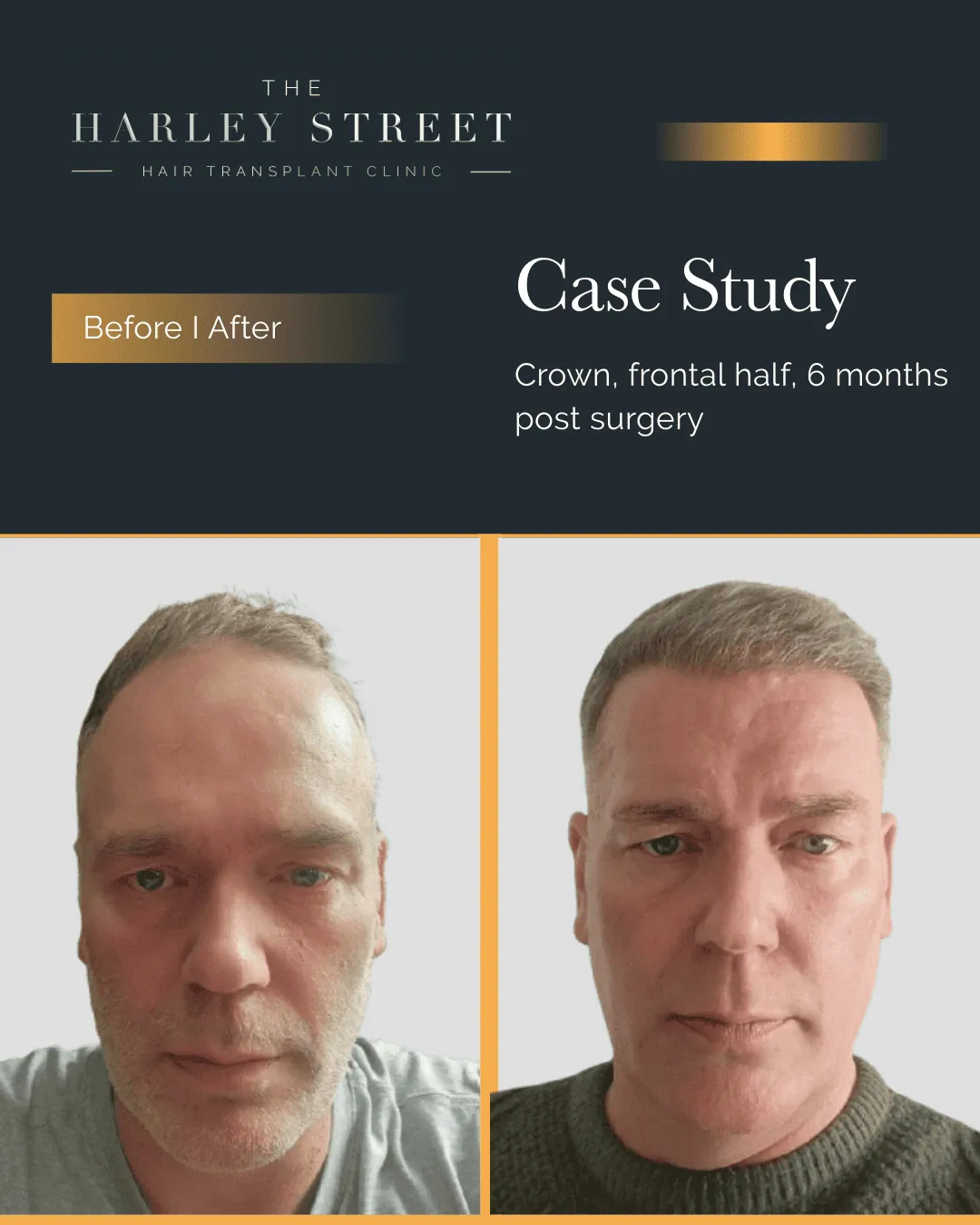 Hair Transplant Before and After Results Harley Street HT Clinics pt, Mark hairline