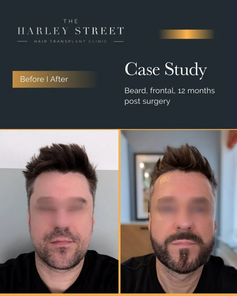 Beard Transplant Harley Street HT Patient Beard - P Burley frontal
