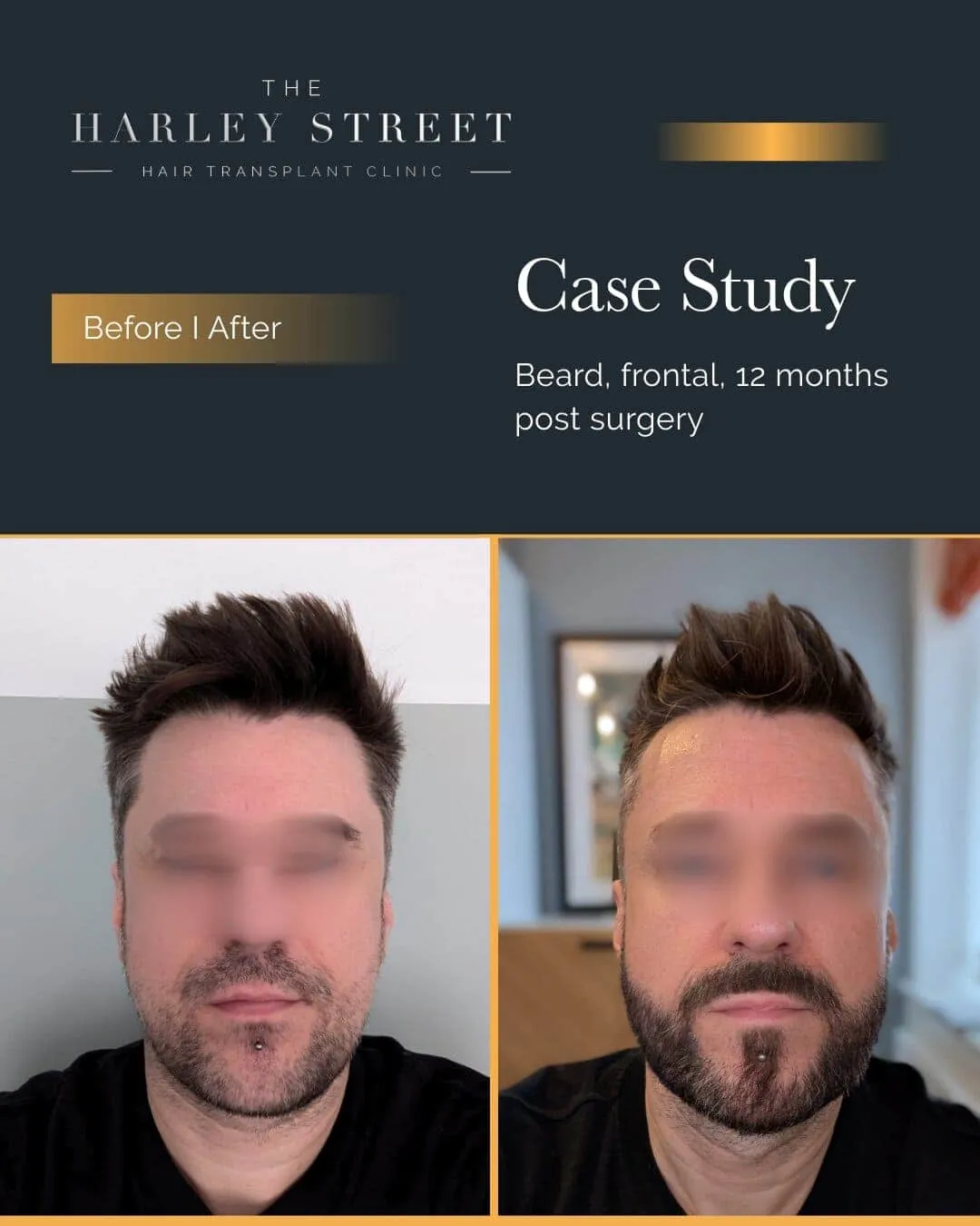 Beard Transplant Harley Street HT Patient Beard - P Burley frontal