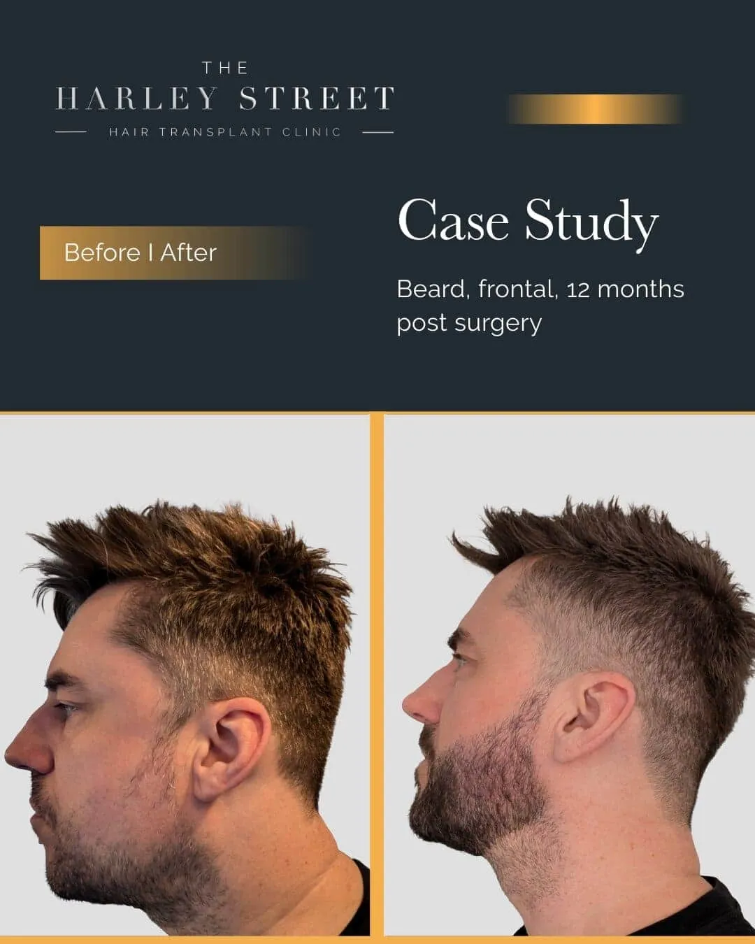 Beard Transplant Harley Street HT Patient Beard - P Burley side