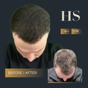 Hairline Hair Transplant Harley Street HT Pt before and after 1