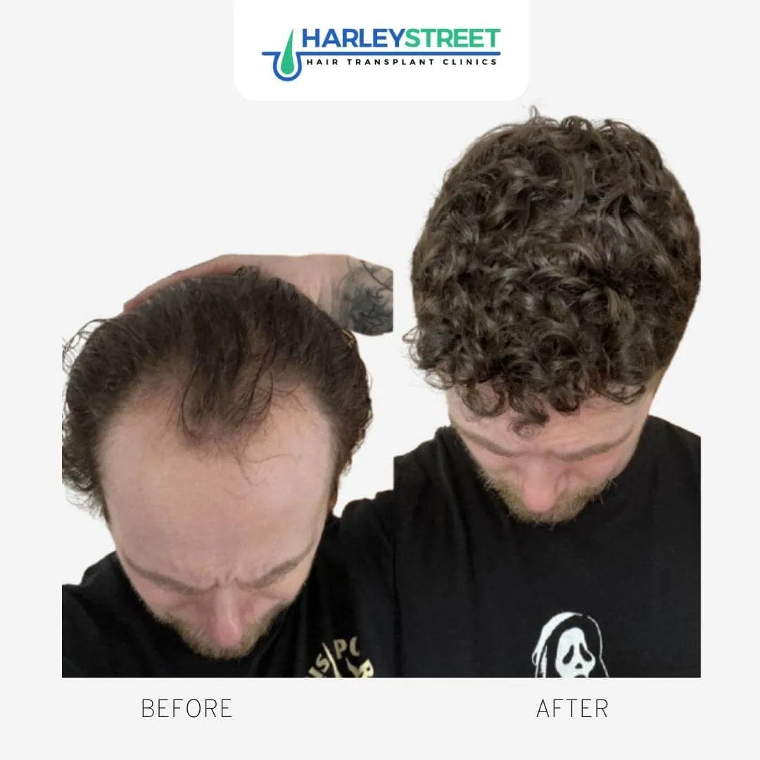 The Recipient Area Explained Harley Street HT Pt before and after