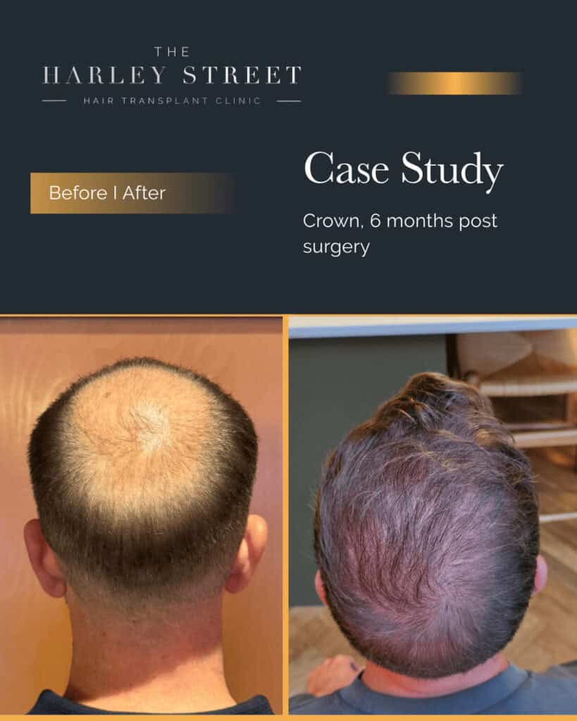 Hair Transplant Stoke on Trent Harley Street HT clinics pt, AS crown large
