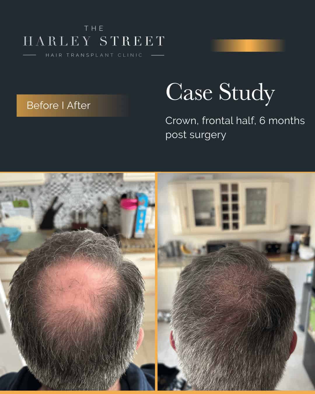 Crown Hair Transplant Harley Street HT clinics pt, Chris H2 crown