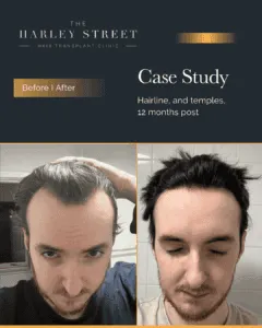 Norwood 3 Harley Street HT patient, Elliot hairline