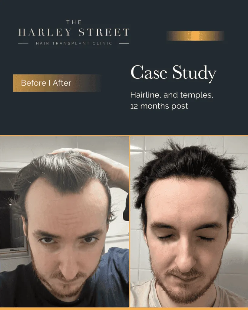 Hair Transplant Reviews Harley Street HT patient, Elliot hairline