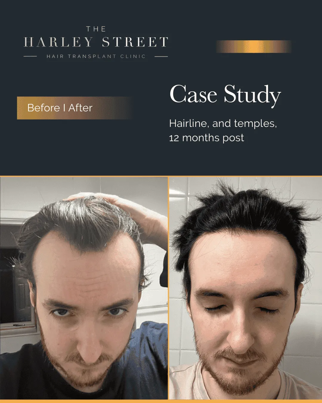 Hair Transplant Manchester Harley Street HT patient, Elliot hairline