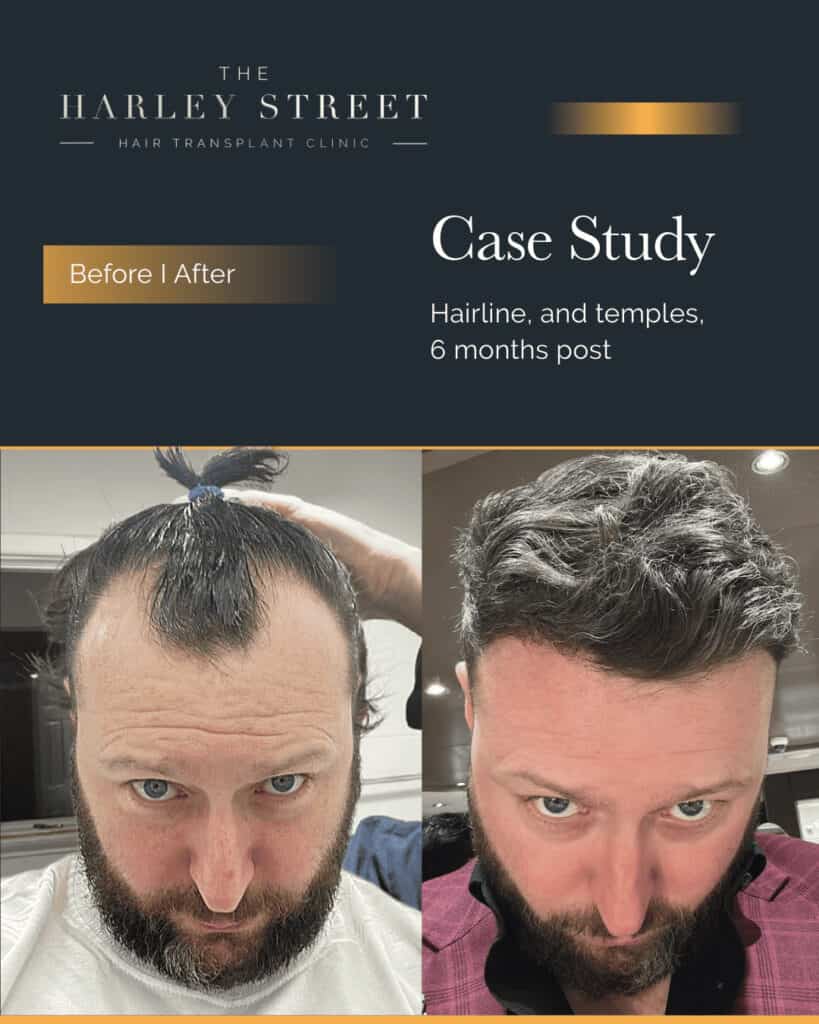 Hair Transplant Aftercare Harley Street HT pt Gerard Walsh hairline