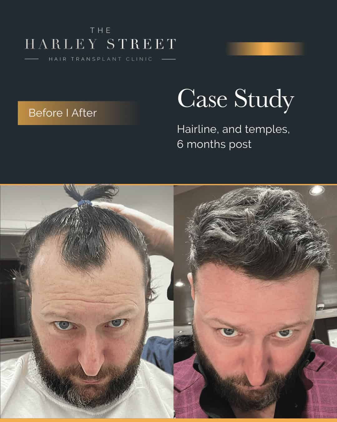 Hair Transplant Reviews Harley Street HT pt Gerard Walsh hairline