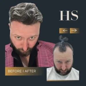 Hairline Hair Transplant Harley Street HT pt Gerard before and after