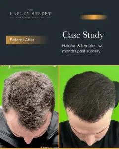 Norwood 3 Harley Street HT pt Gill hairline