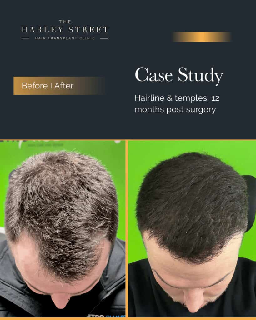 Hair Transplant Aftercare Harley Street HT pt Gill hairline
