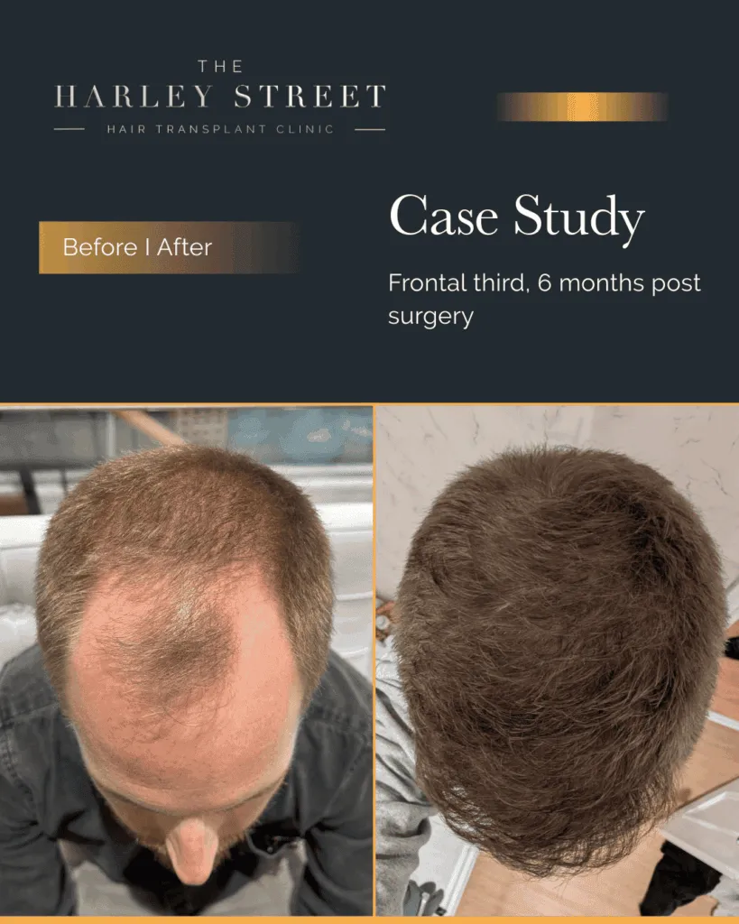 Hair Transplant Aftercare Harley Street HT pt Hughes, hairline aerial view