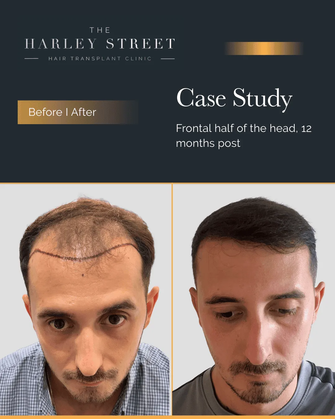 Hair Transplant Reviews Harley Street HT pt Ilir frontal 3rd